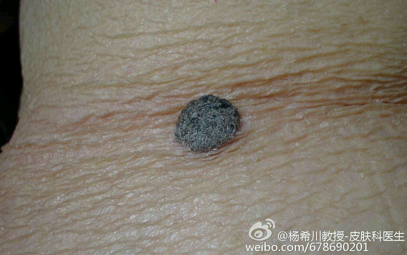杨教授每周病例分享#:脂溢性角化 - 春雨医生
