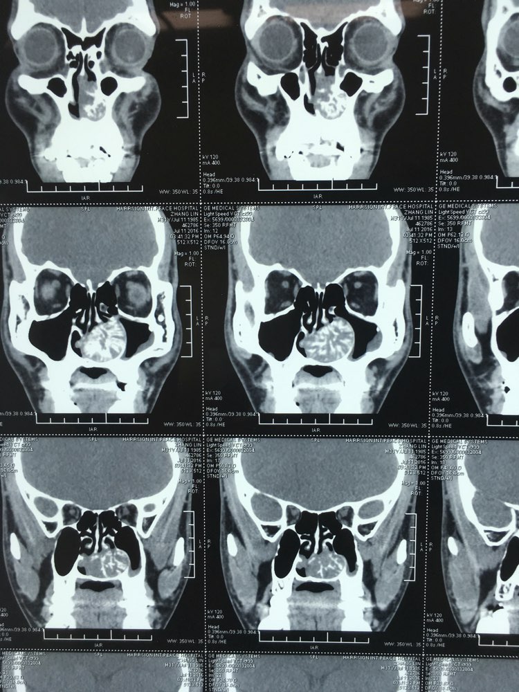 CT筛窦图片
