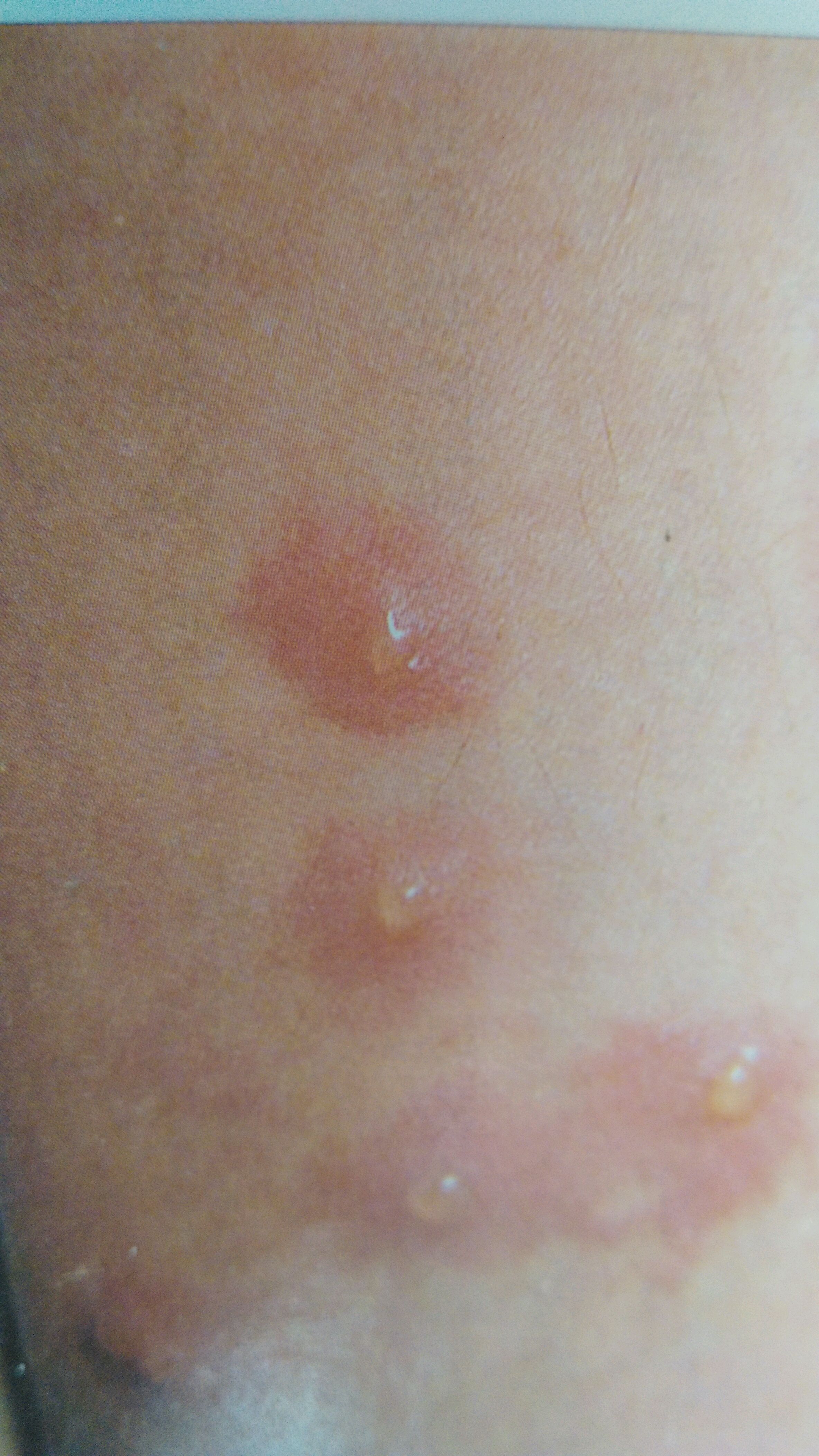 儿童常见季节性过敏性皮肤病-丘疹性荨麻疹