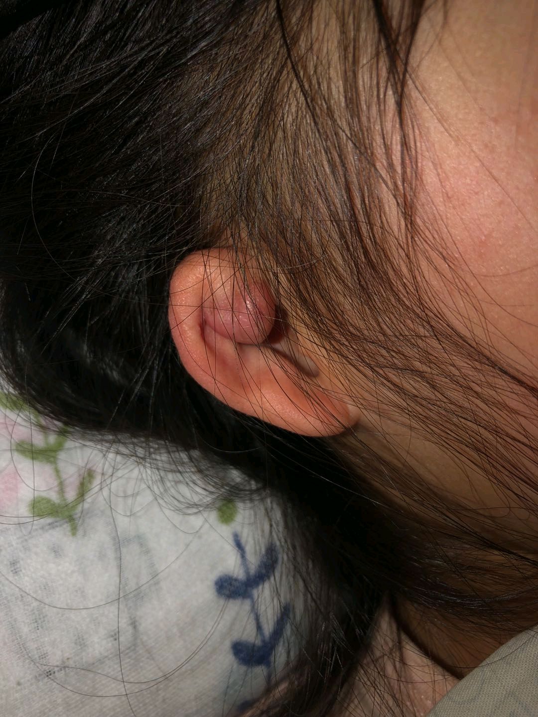 耳垂或耳廓瘢痕疙瘩如何治疗?