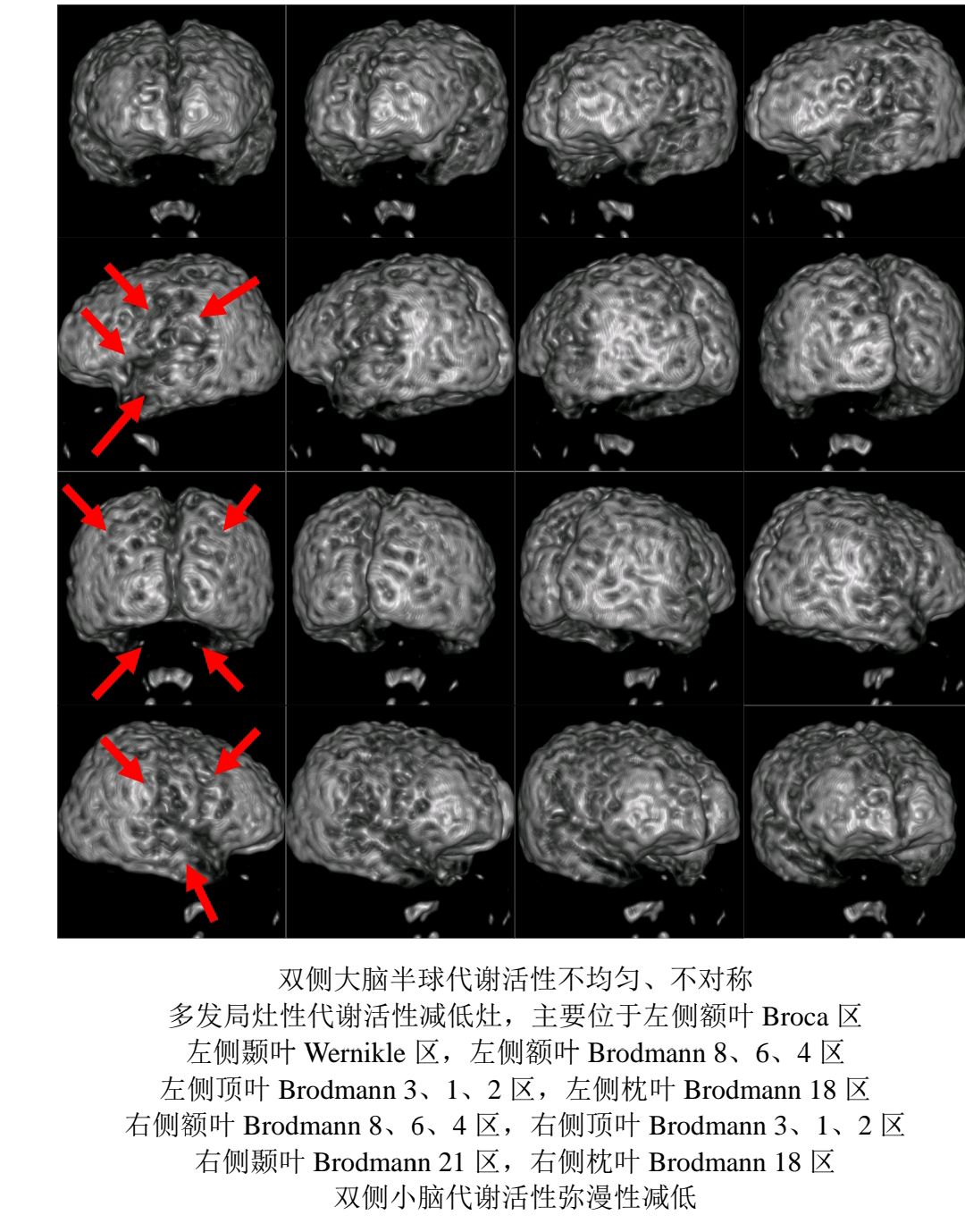 自闭症患儿pet/ct发现全脑葡萄糖代谢减低,特别是语言中枢broca区和