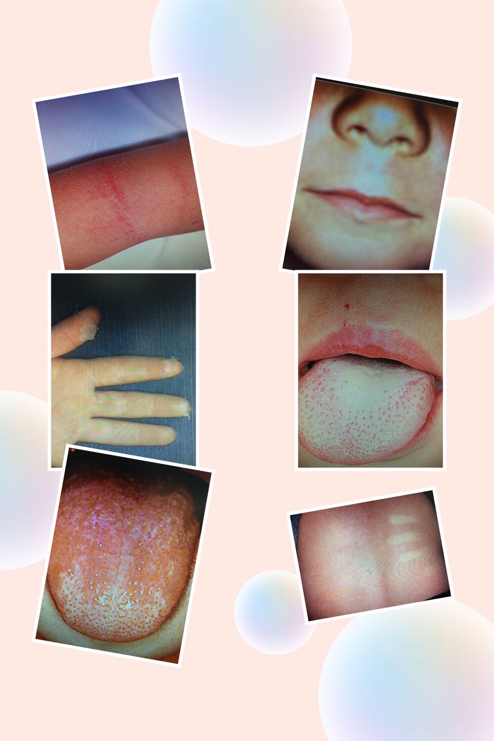 皮疹鉴别很困难傻傻分不清张传印医生用诗图让你分分钟掌握儿科常见