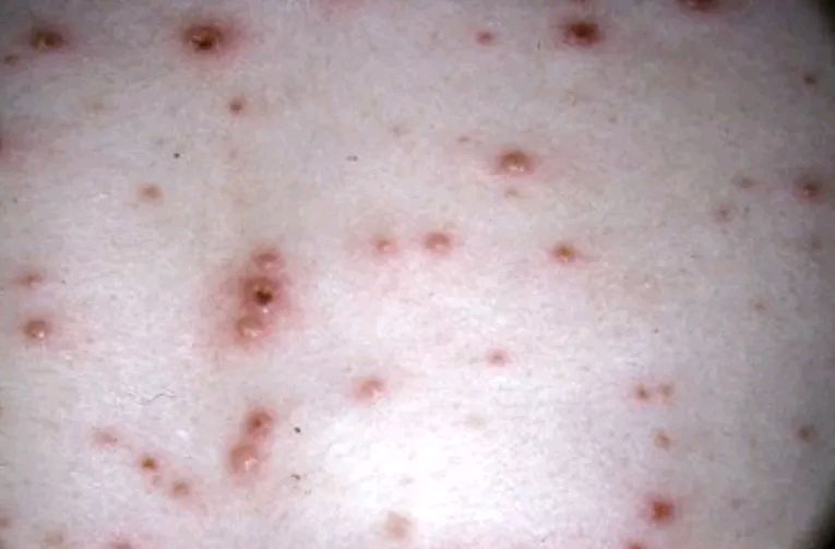 特征性水疱;然后这些病损可发展为脓疱疹,随后形成结痂(图4),皮疹结痂