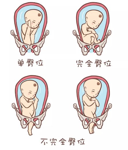 宝宝是臀位,在孕期不会直接影响妈妈的健康,但会增加妈妈剖宫产分娩的