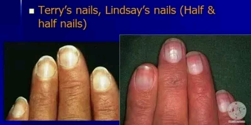 特里甲横白纹甲任何急性病都可能产生横白线,也称为"米氏线".