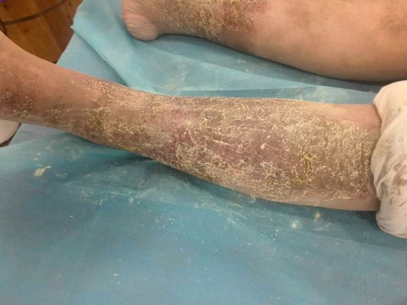 湿疹,过敏性皮炎,神经性皮炎,药物性皮炎等属于风热或风湿所致者