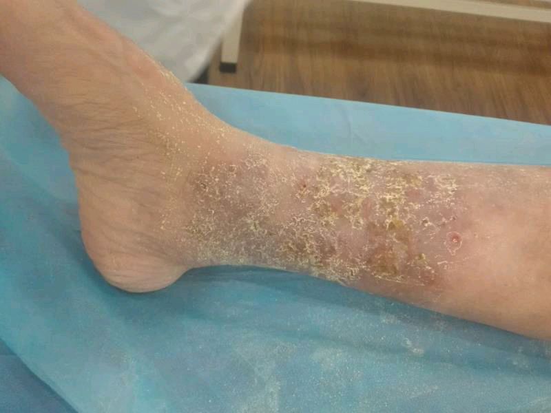 湿疹,过敏性皮炎,神经性皮炎,药物性皮炎等属于风热或风湿所致者