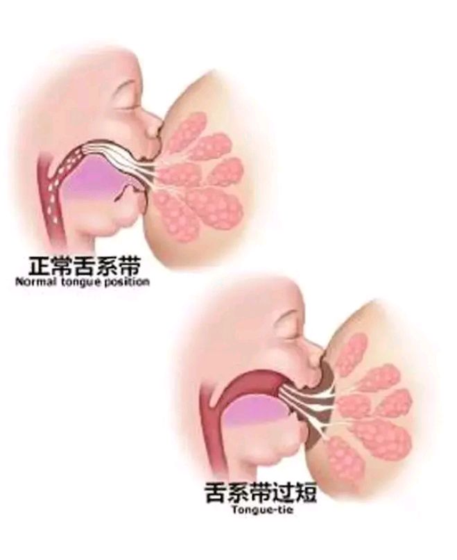 怎么判断宝宝舌系带短治疗又是怎样的呢