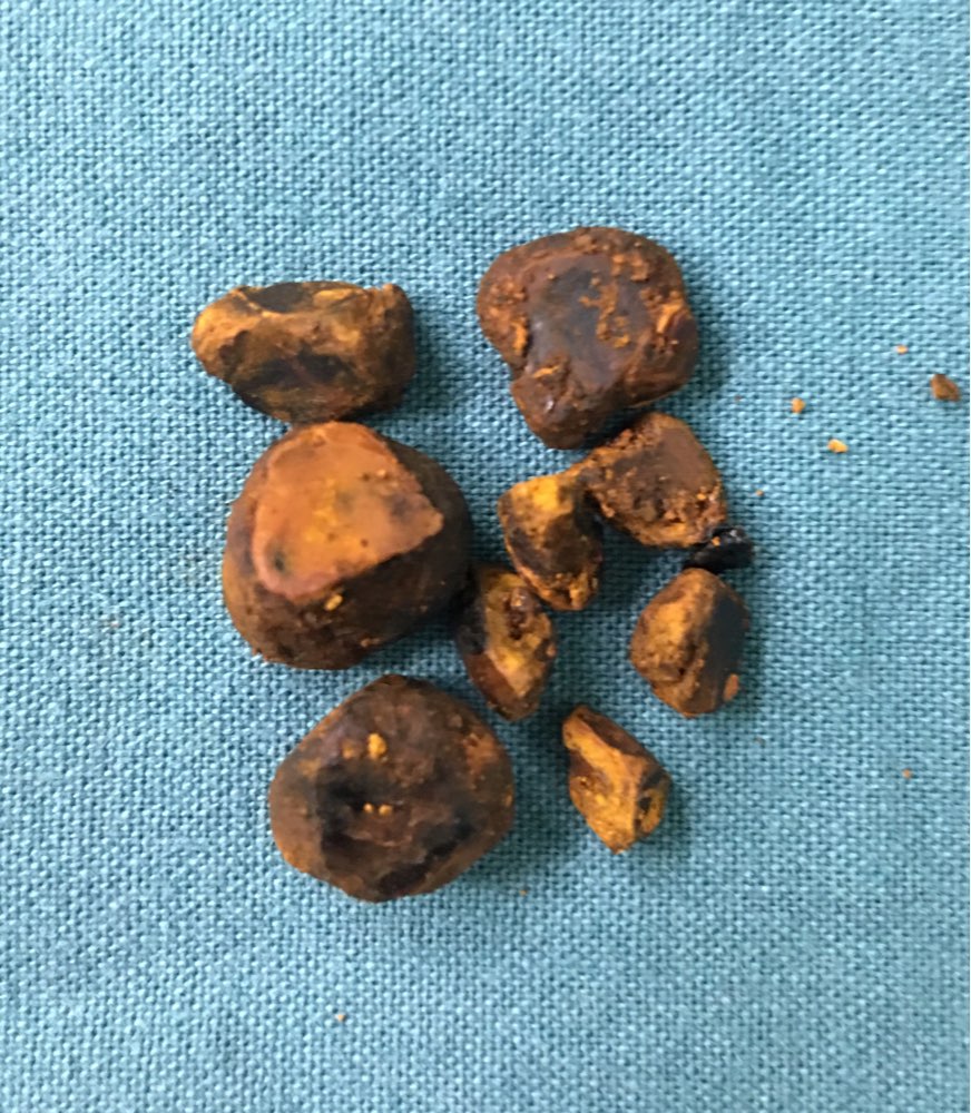 认识胆总管结石 - 春雨医生