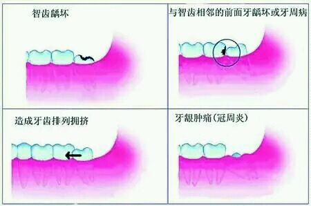 智齿冠周炎到底可不可怕?