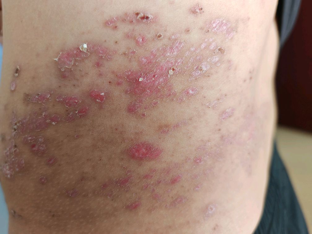艾滋病病人的带状疱疹