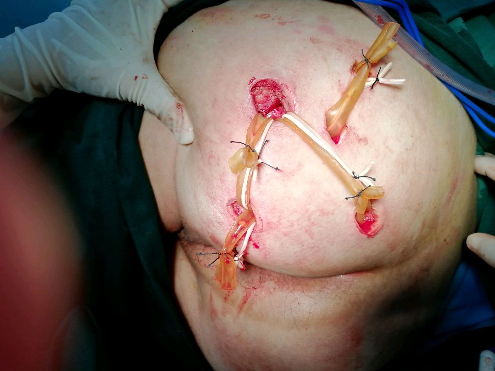 坏死性筋膜炎 手术图片