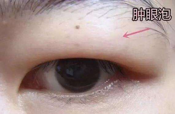 一,单纯性脂肪肿泡眼,可以先做上睑部脂肪去除,就是通过一个小眼,将上