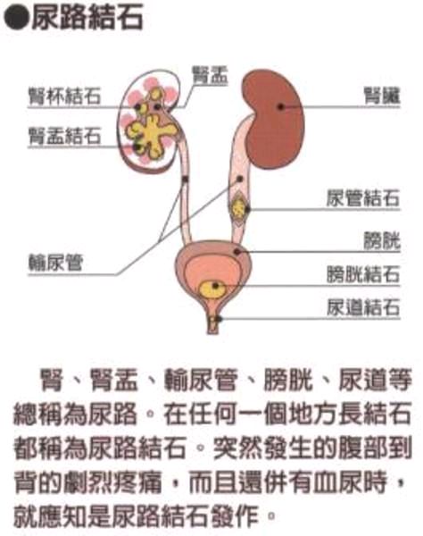 泌尿系结石包括肾结石,输尿管结石,膀胱结石和尿道结石