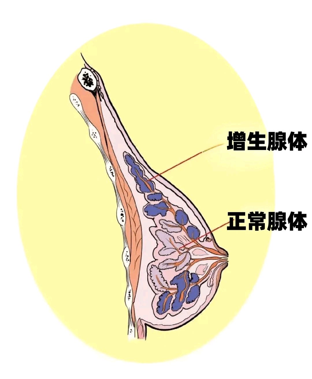 男士乳腺腺体增生图片