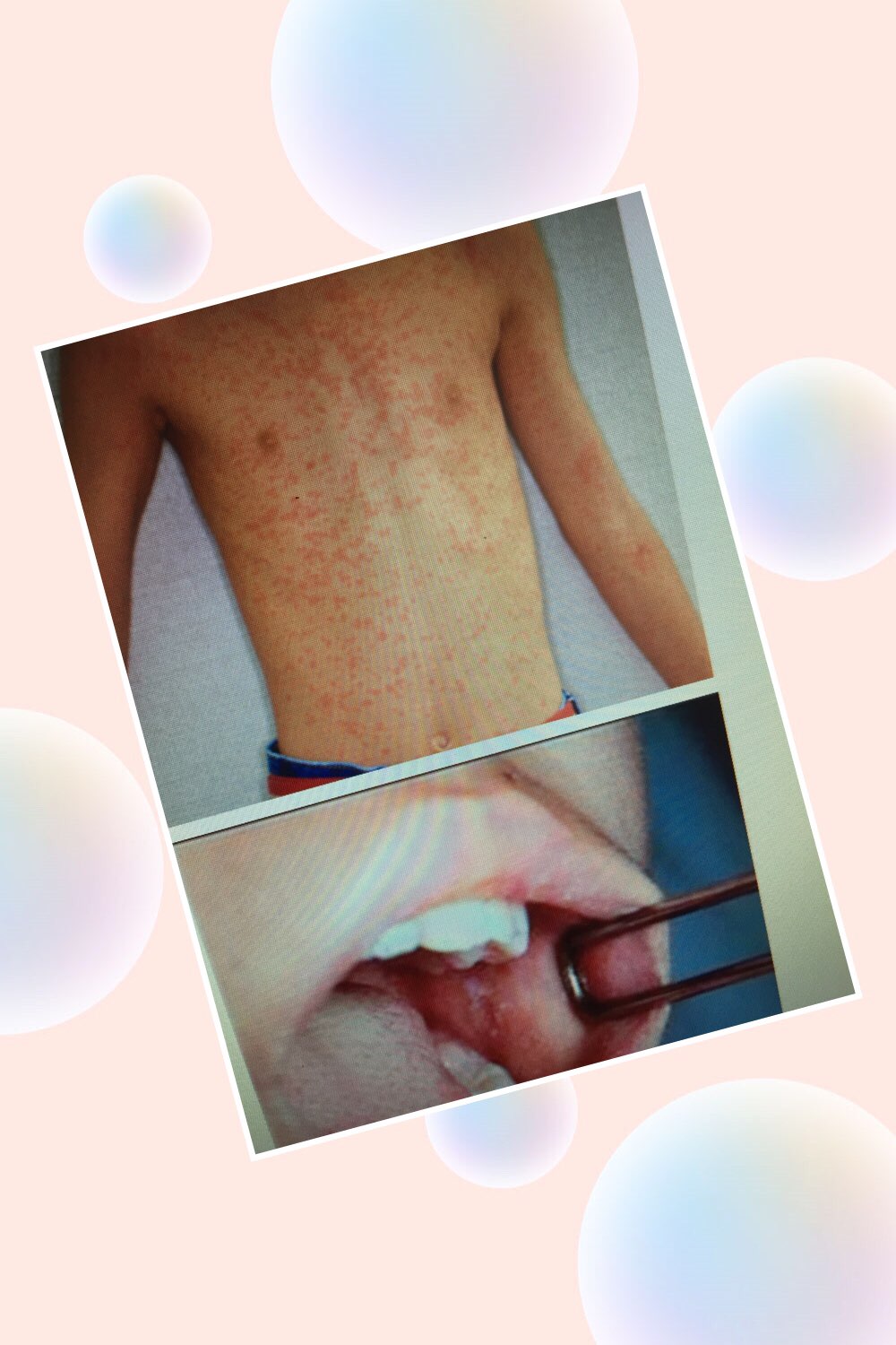 皮疹鉴别很困难傻傻分不清张传印医生用诗图让你分分钟掌握儿科常见