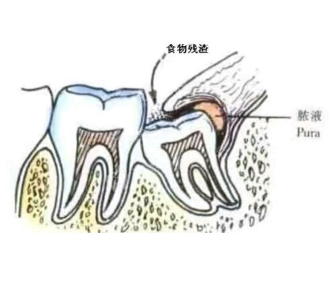 智齿长在什么位置图片