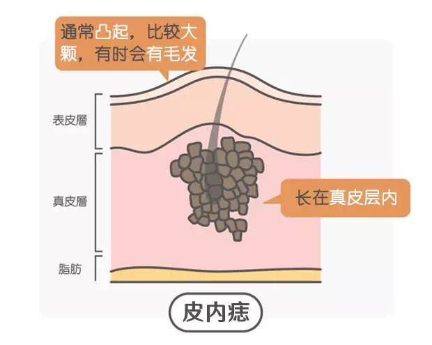 肉痣图片图解图片