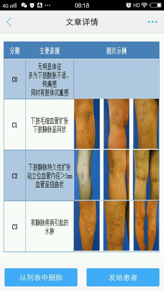 下肢静脉曲张临床分级图片