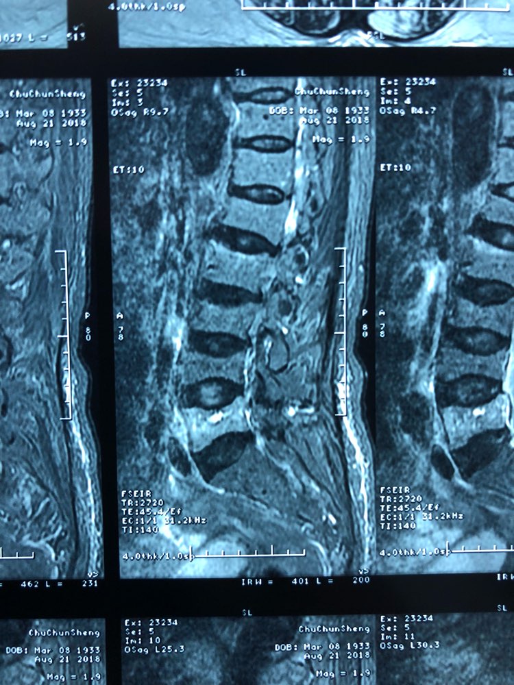 骨质疏松性椎体压缩性骨折怎么治疗