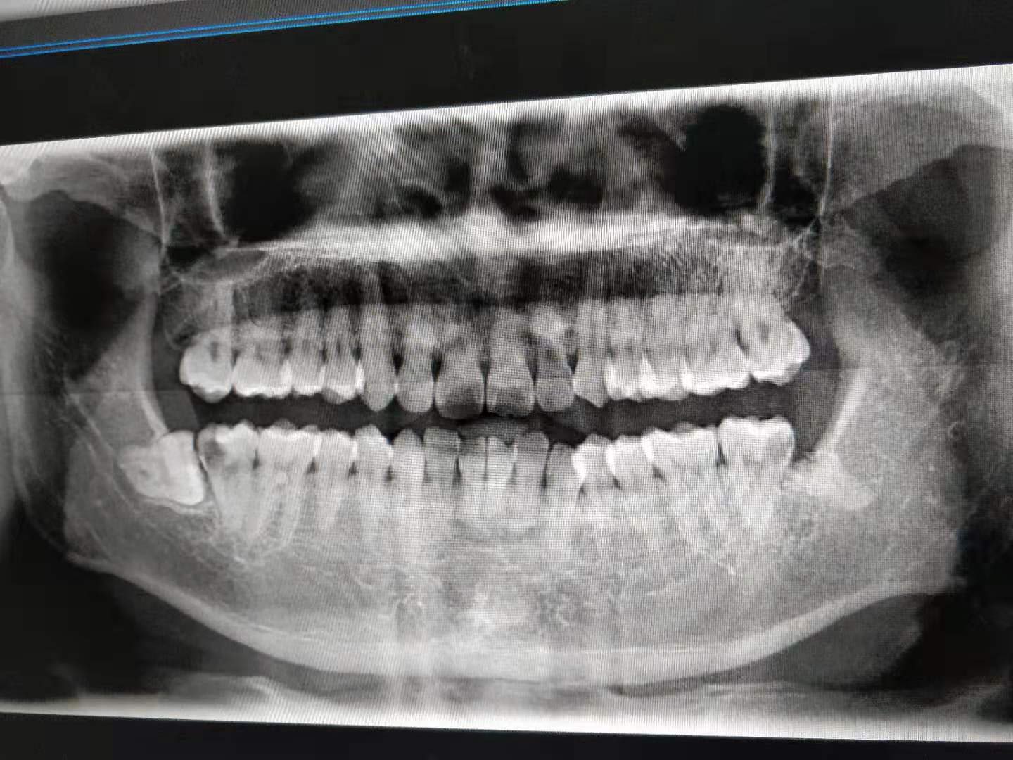 牙髓炎x光片图片