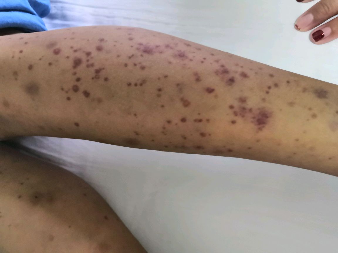 过敏性紫癜