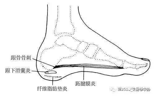 常见足跟部疼痛诊断及治疗