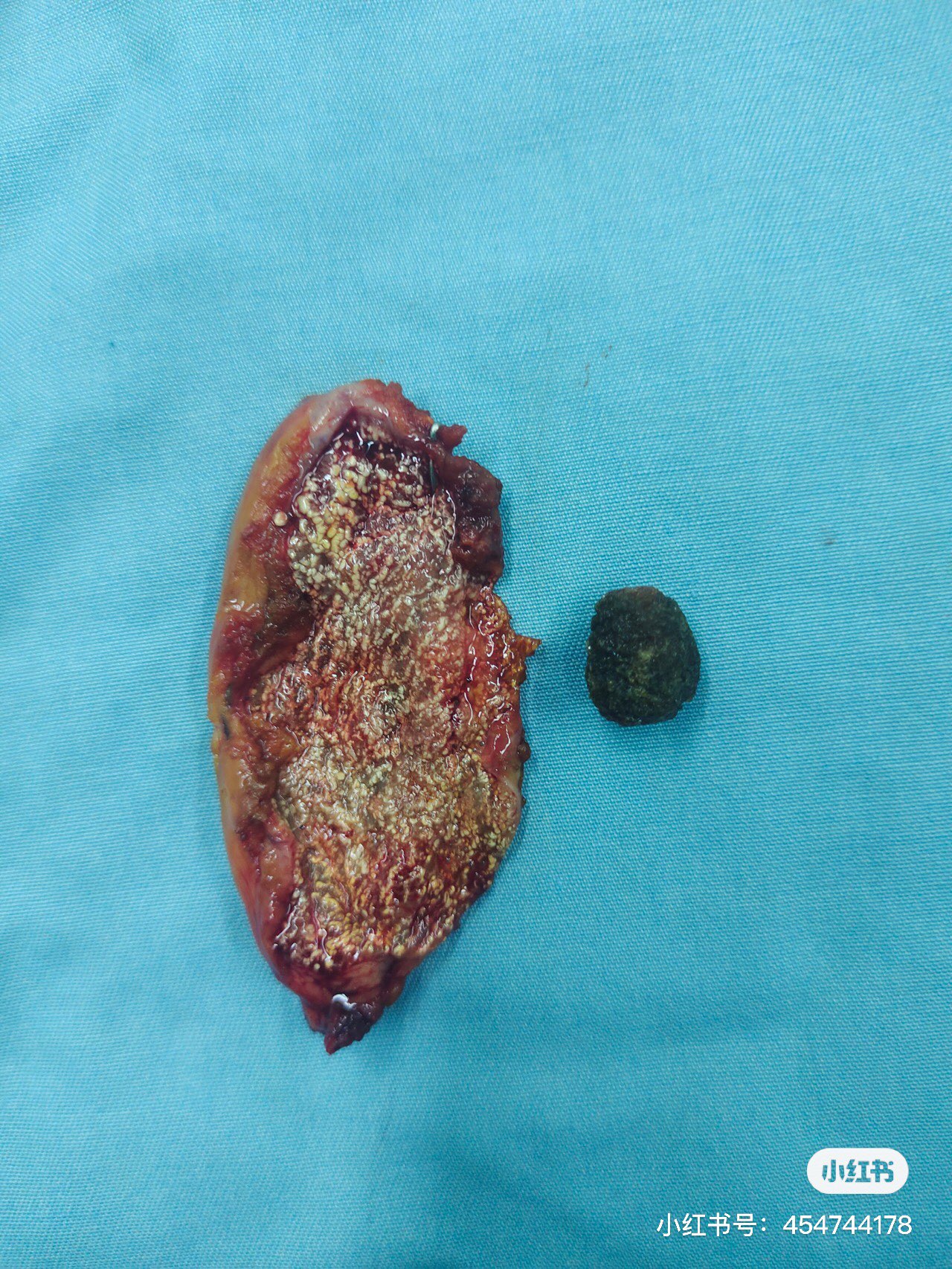 单孔 超微创胆囊切除术