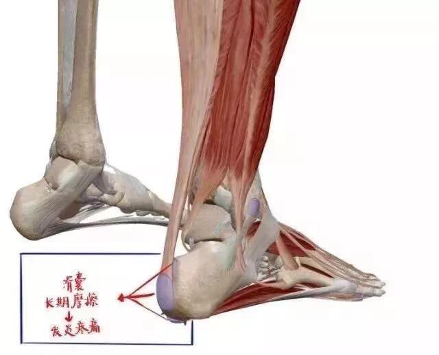 走路脚跟痛当心跟痛症