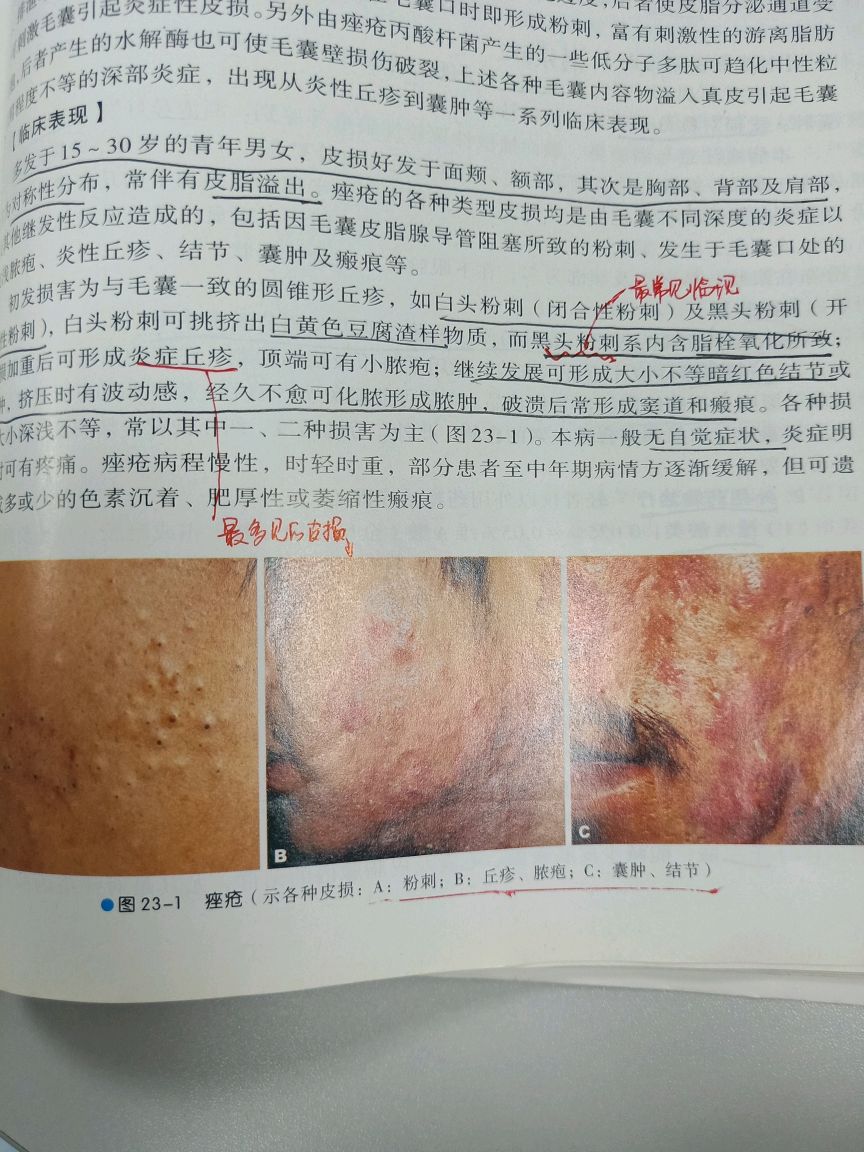 影响一波人的颜值的痘痘肌诊治科普- 春雨医生