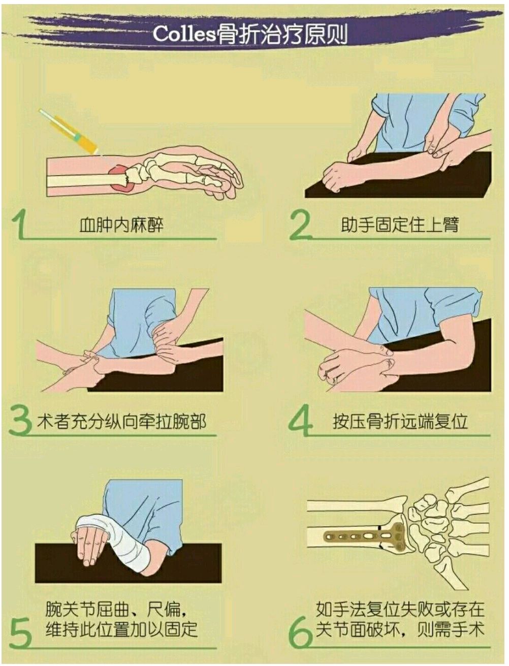 怎樣處理colles骨折才能恢復快