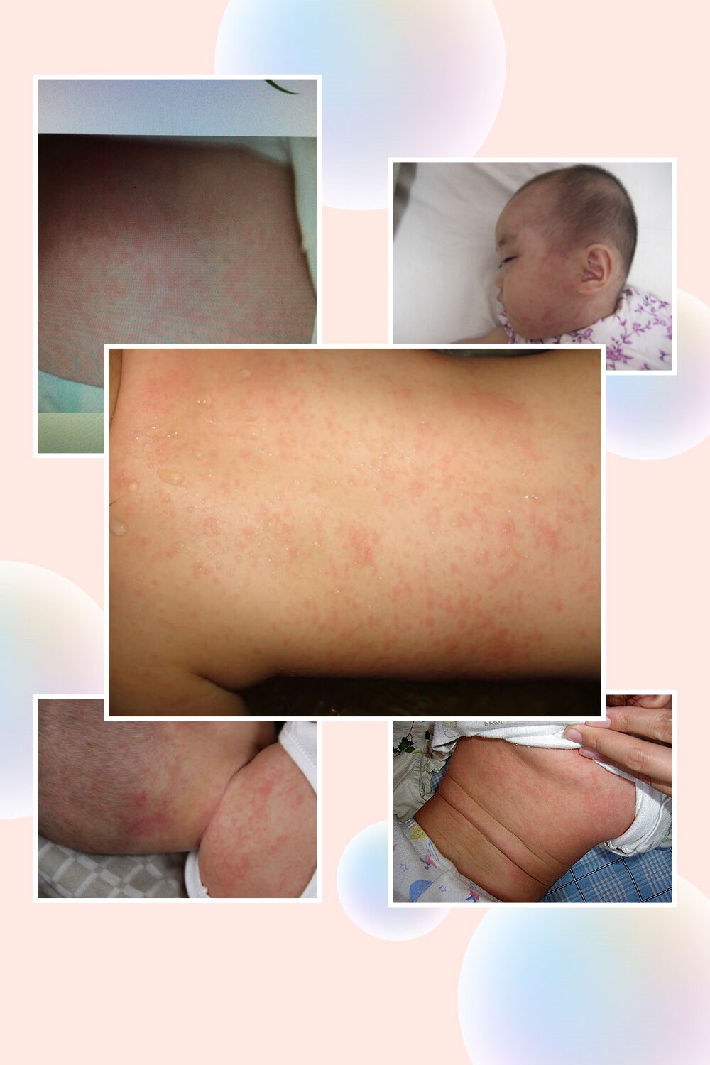 皮疹鉴别很困难傻傻分不清张传印医生用诗图让你分分钟掌握儿科常见