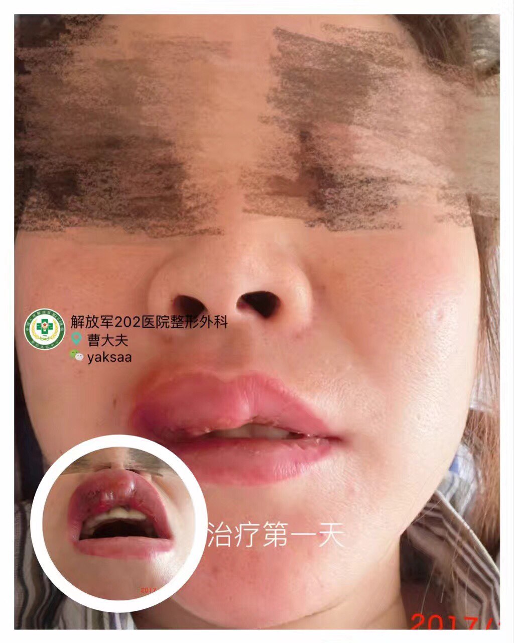 假玻尿酸,注射唇部后,肿胀破溃,治疗过程