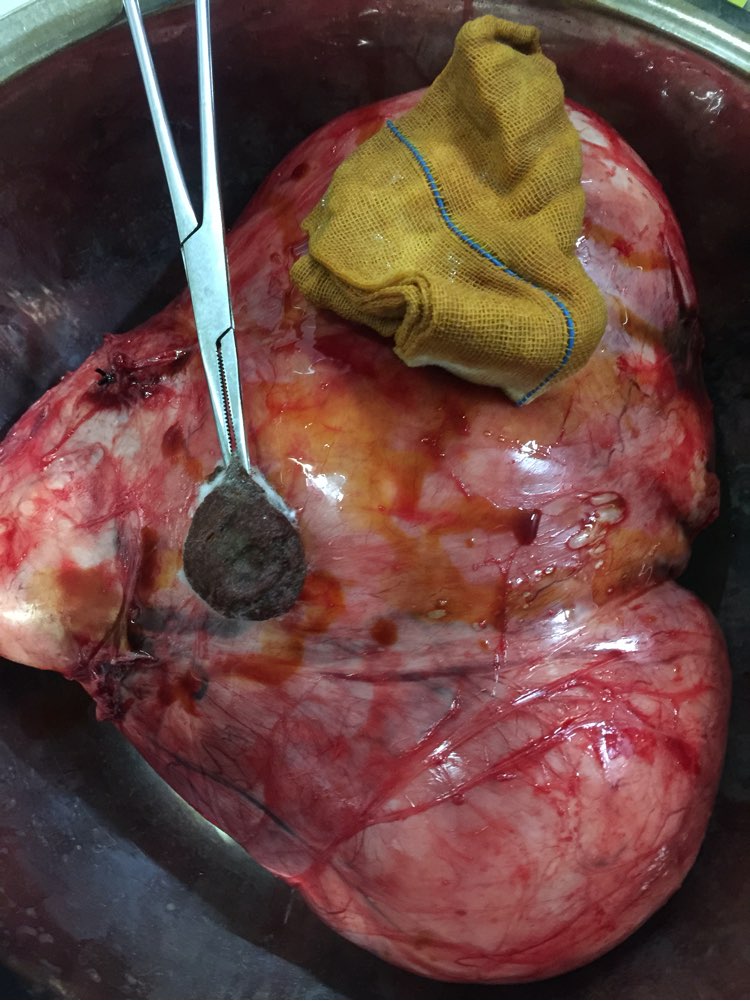 2500克巨大子宫肌瘤