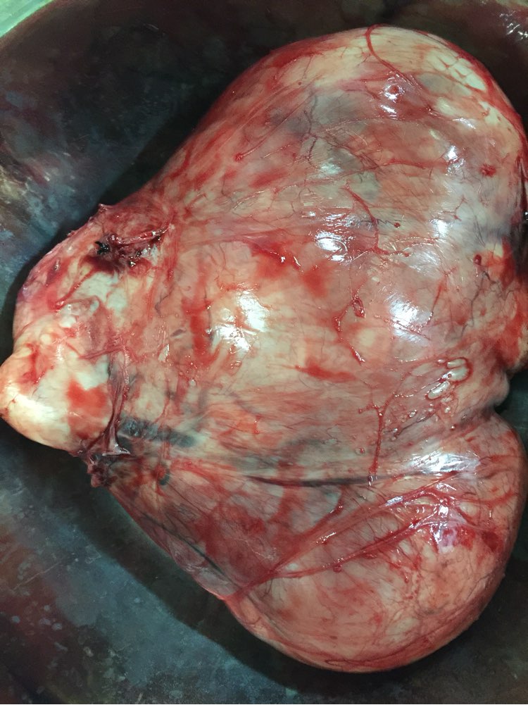 2500克巨大子宫肌瘤