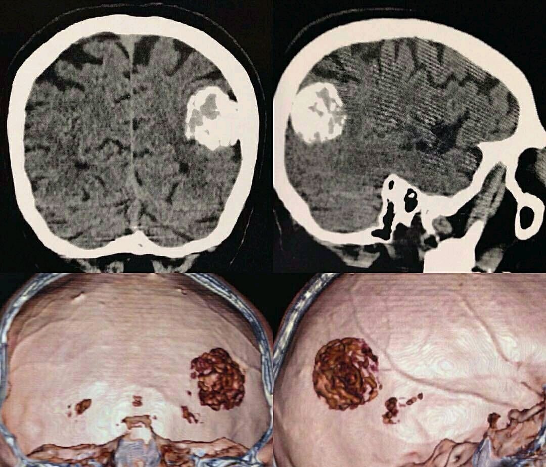 脑膜瘤生长缓慢,其临床表现取决于肿瘤起源部位,大小及其对邻近脑组织