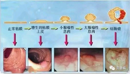 山田息肉分型图谱图片