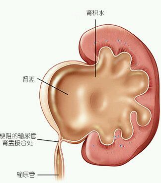泌外小杨之肾积水浅谈