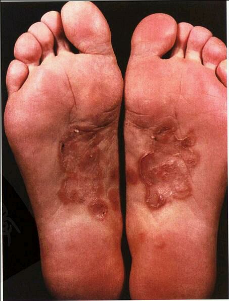 梅毒的可怕和可爱