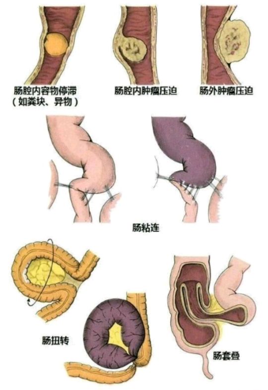 不完全性肠梗阻麻痹图片