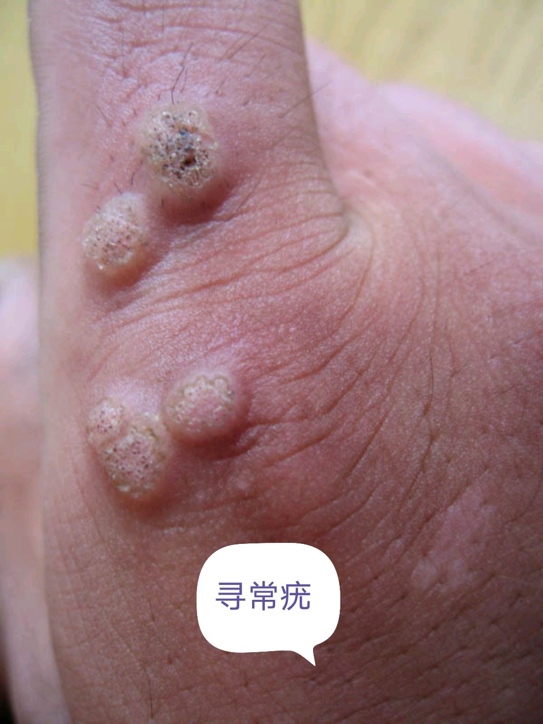 有的还可以出现黑色的点状出血,我们称为寻常疣,长在脚底的叫做跖疣