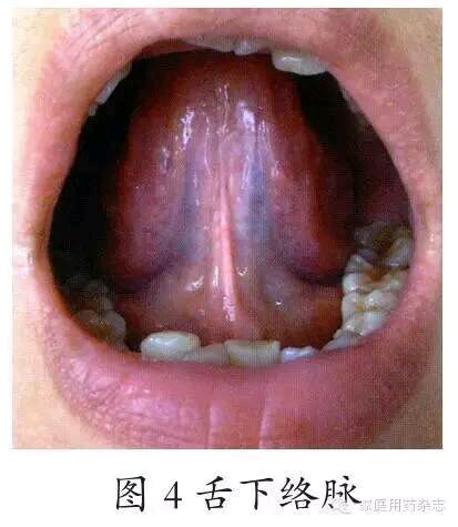 拍舌苔的示例照片图片