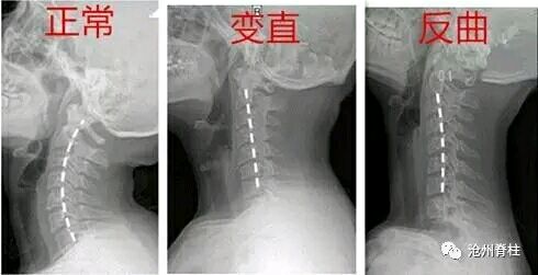 颈部肌肉不能维持颈椎正常的生理曲度,从而导致颈椎曲度变直或反曲