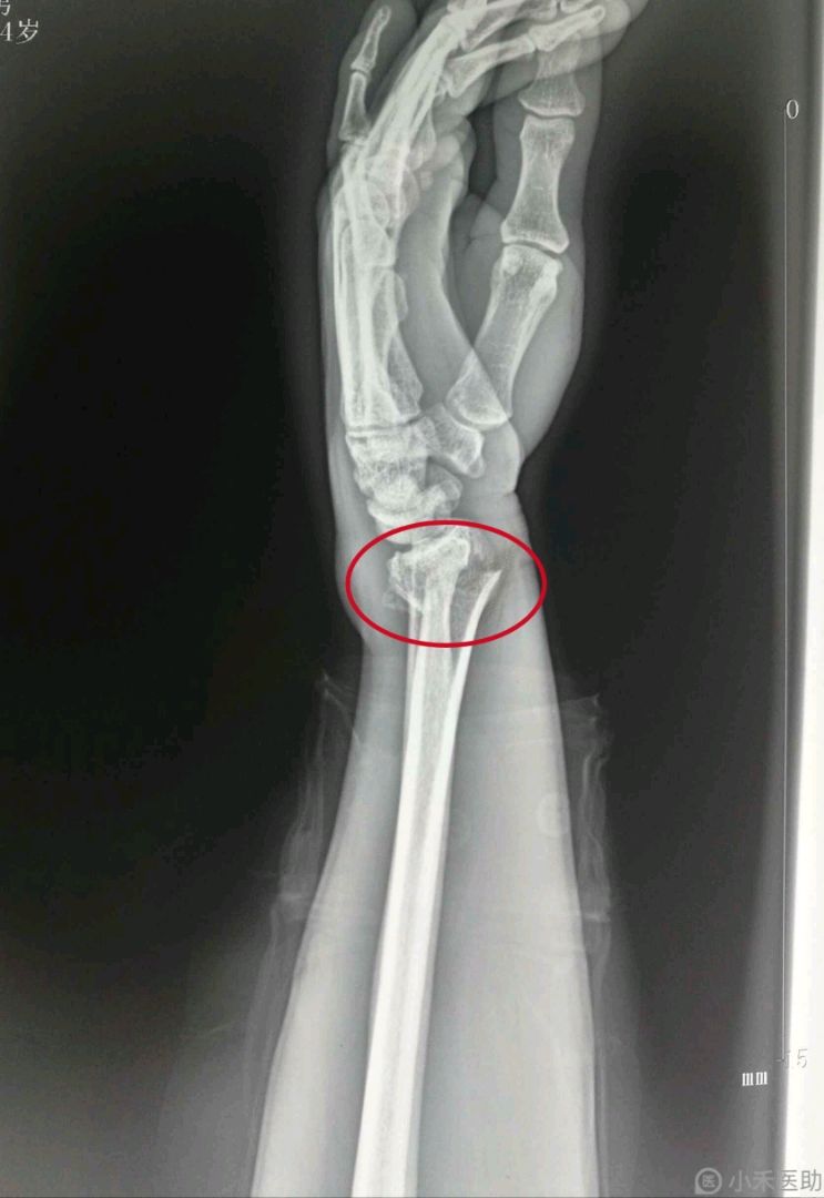 左桡骨远端青枝骨折图片