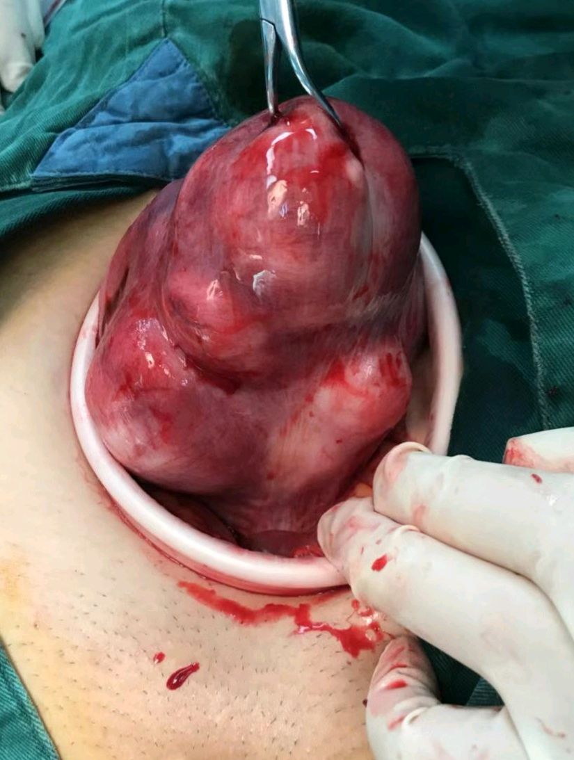 子宫肌瘤真实图片图片