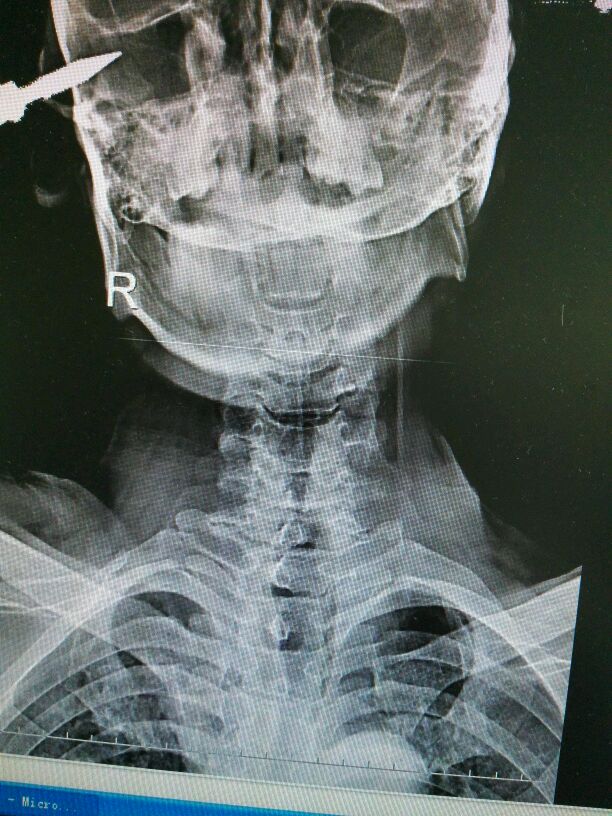 颈椎创伤性滑脱不稳