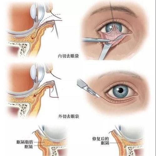 泪前隐窝入路手术步骤图片
