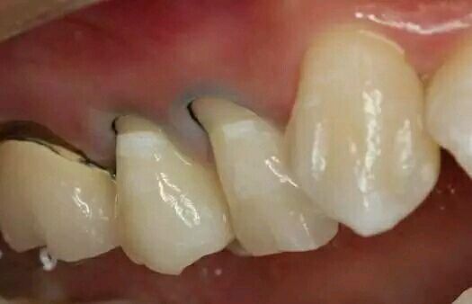 牙齿楔状缺损,别以为仅是横向刷牙!