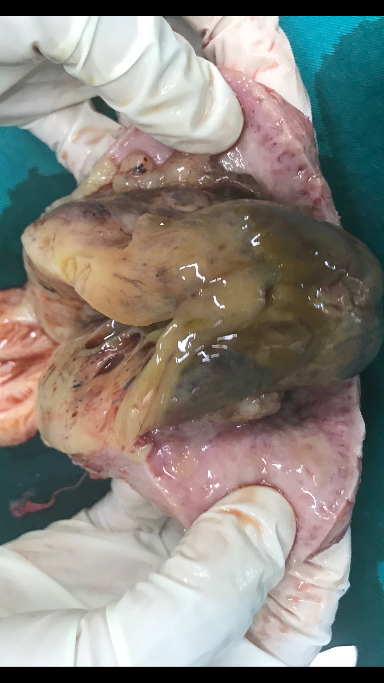 子宫内膜间质肉瘤