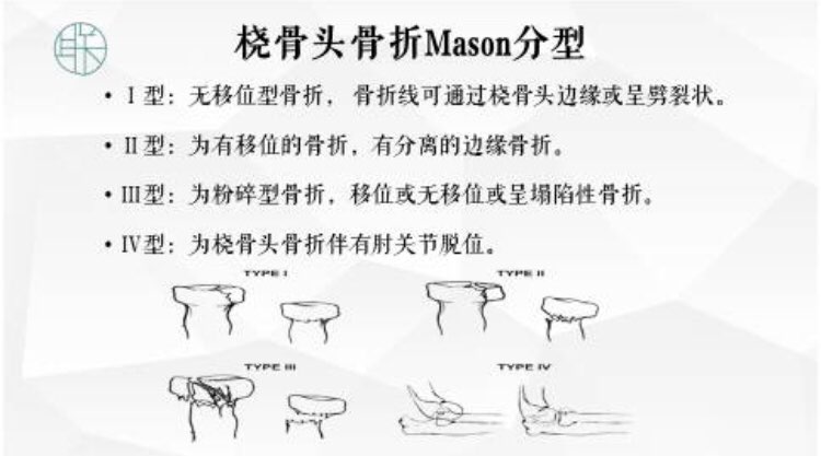mason分型示意图图片